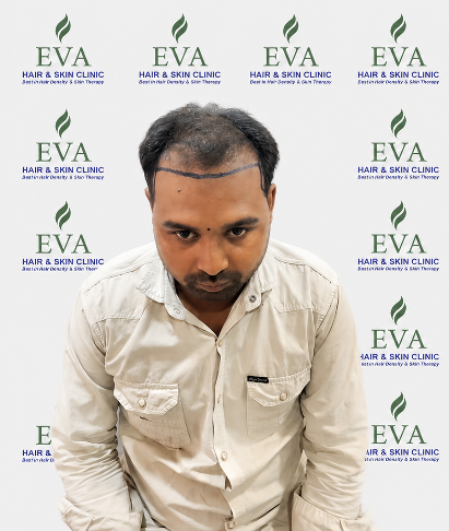 Before hair transplant result 11
